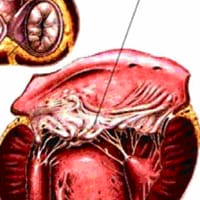 Chronic Valvular Disease
