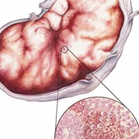 Canine Lymphosarcoma