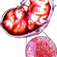 Feline Lymphosarcoma