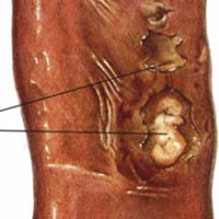 Chronic Colitis