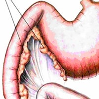 Exocrine Pancreatic Insufficiency