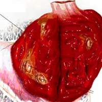 Hemorrhagic Gastritis with Ulcers