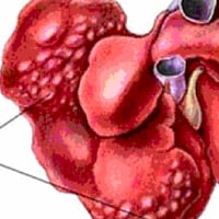 Hepatic Neoplasia