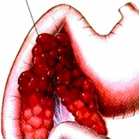 Pancreatitis