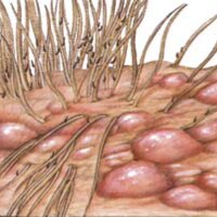 Flea-Allergy Dermatitis