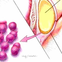 Skin Abscess