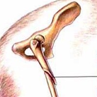 Femoral Fracture