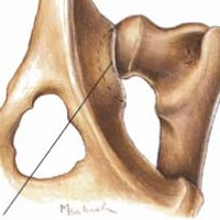 Hip Dysplasia
