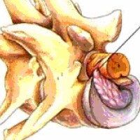 Intervertebral Disk Disease