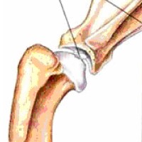 Osteochondritis Dissecans