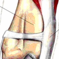 Patellar Luxation