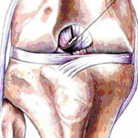 Ruptured Cranial Cruciate Ligament