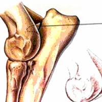 Ununited Anconeal Process