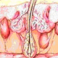 Demodex