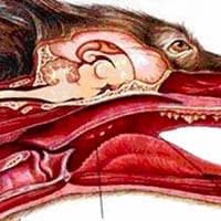 Tonsillitis