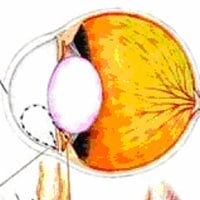 Glaucoma