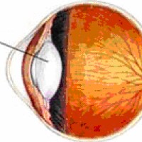 Nuclear Sclerosis and Cataracts