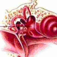 Otitis Externa, Media and Interna