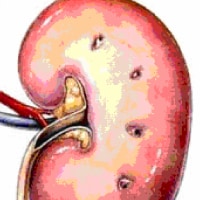 Acute Renal Failure