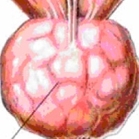Benign Prostatic Hyperplasia