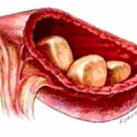 Bladder Stones
