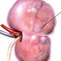 Chronic Renal Failure