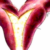 Pyometra