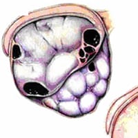 Testicular Tumors
